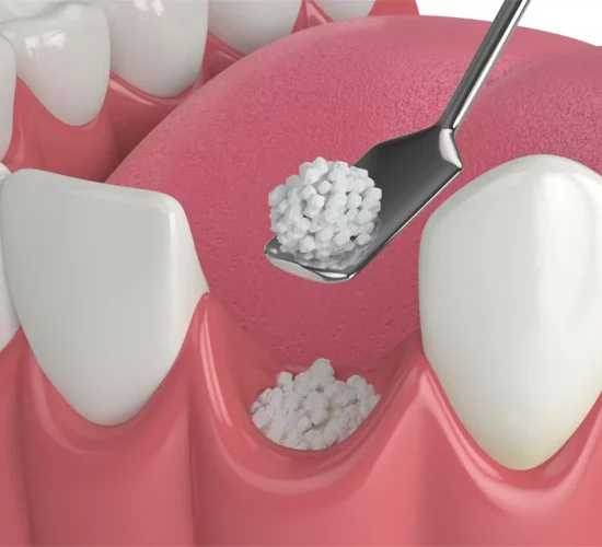 Dental Bone Grafting