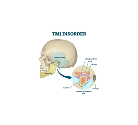 TMJ Disorder