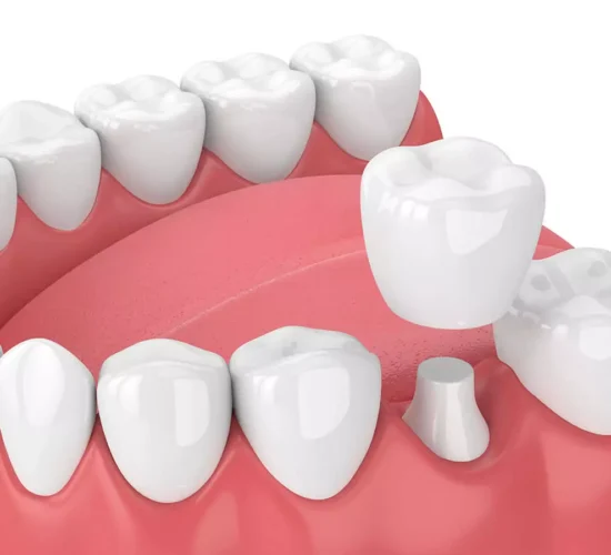 Dental Crowns and Bridges