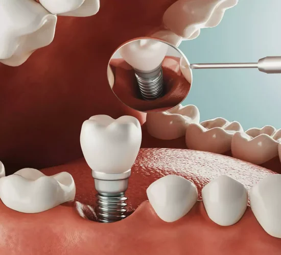 Dental Implants