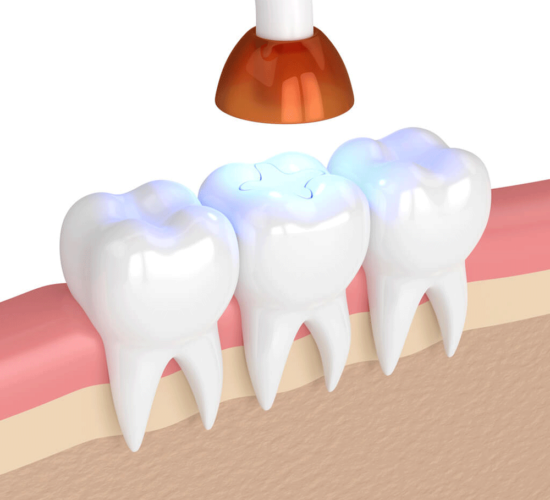 Tooth Fillings and Sealants