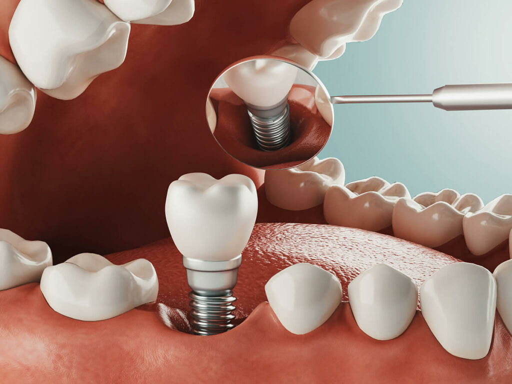 graphic of a dental implant being placed with a mirror in the mouth