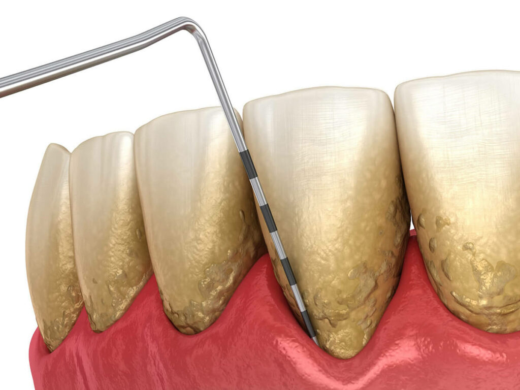 graphic of gums being measured for gum disease