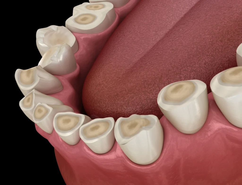 graphic of grinded down teeth