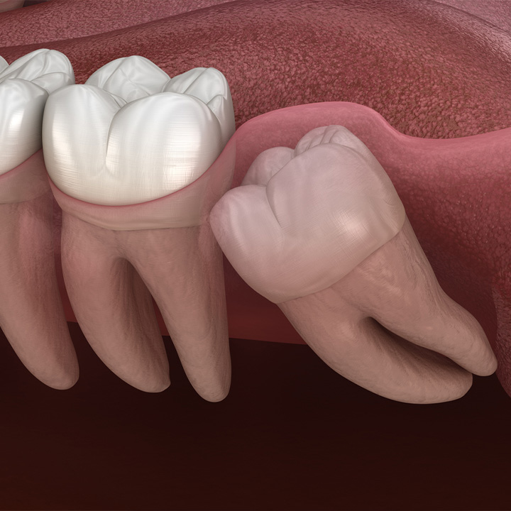 graphic of an impacted wisdom tooth
